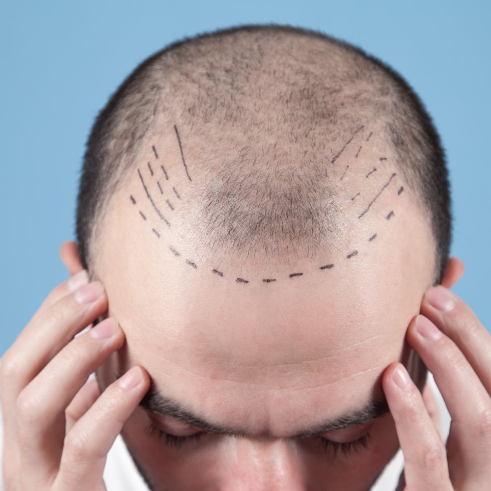 Haar Transplantatie